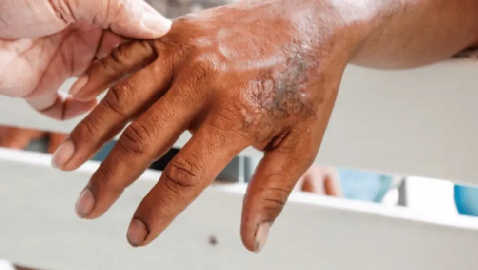 Губа у Хрватској