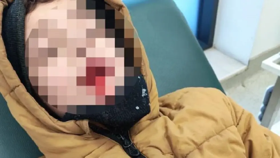 Пас луталица откинуо дјетету горњу усну